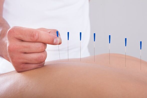 Acupunctură