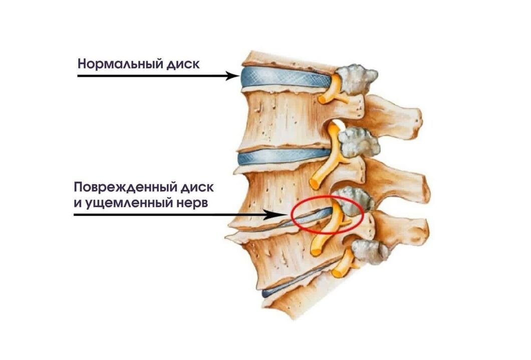 Simptomele osteochondrozei cervicale