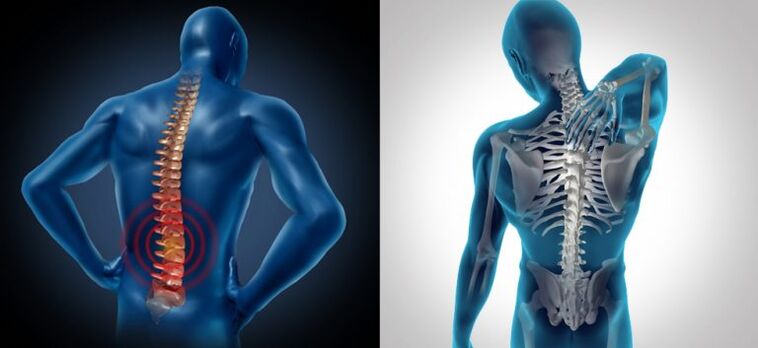 Inflamarea în osteocondroza coloanei vertebrale