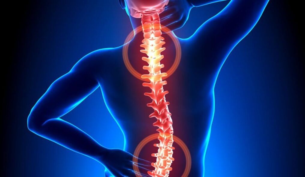 osteocondroza coloanei vertebrale