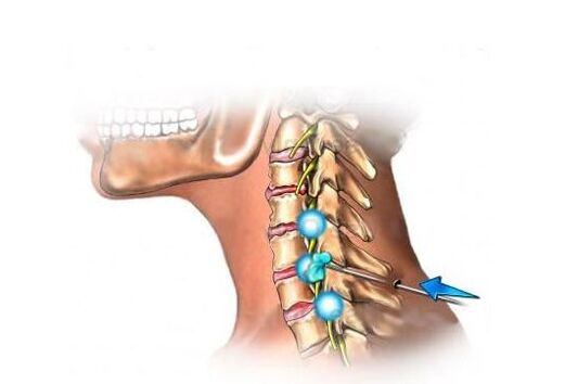 tratamentul osteocondrozei cervicale